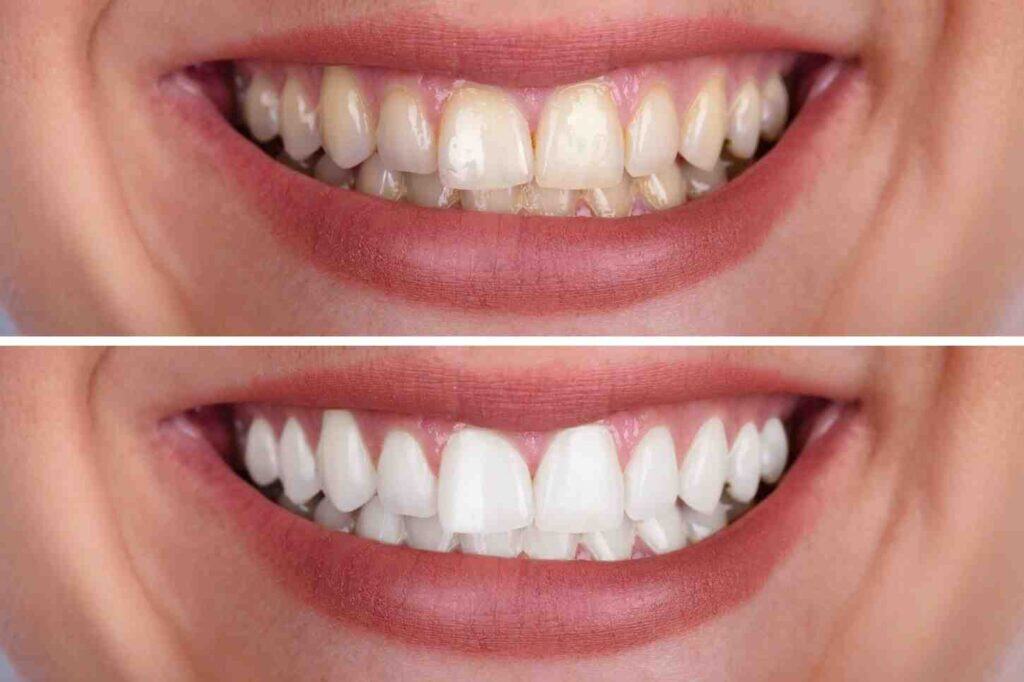 Close-up of a Blue Light Teeth Whitening session with safety shields and modern equipment Buckhurst-Hill