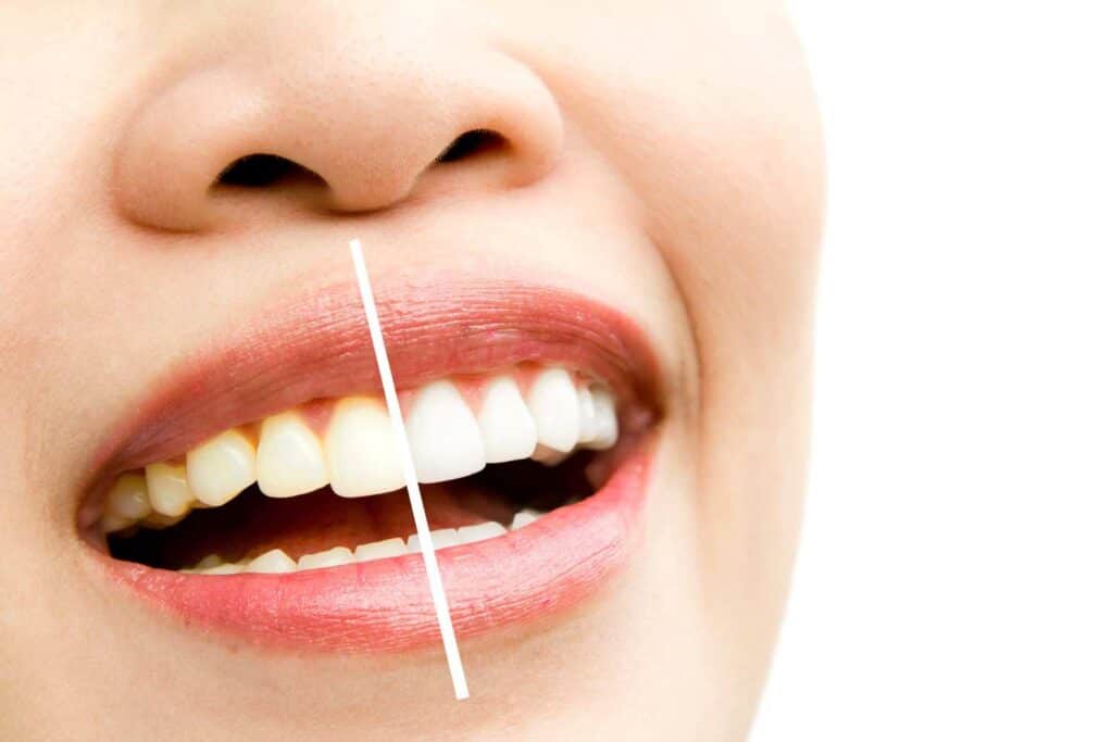 Can I Maintain My New Smile If I&rsquo;m a Coffee or Red Wine Lover Buckhurst-Hill